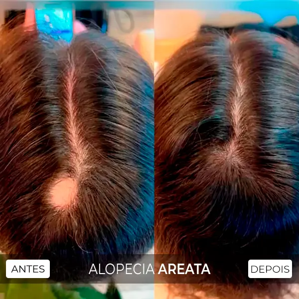alopecia areata