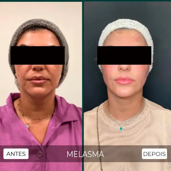 melasma