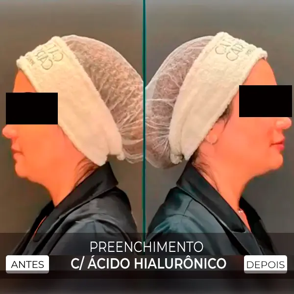 preenchimento com ácido hialuronico
